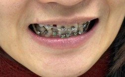 矫正牙齿被拉开间隙