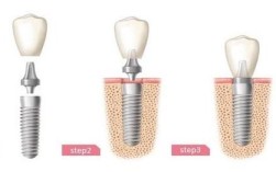 种牙对口腔有伤害吗？潜在风险与好处解析