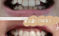 天津隐形牙齿矫正效果如何？价格多少？适合哪些人群？