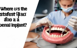 2025种植牙安全，去哪儿做更靠谱？