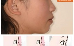 牙齿矫正真能改变脸型？效果因人而异吗？