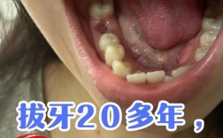 种牙前拔牙根会疼吗？拔牙根的痛感强不强，术后恢复需要注意什么？