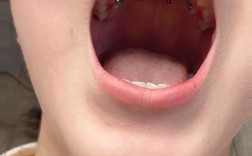 正畸隐形矫治器开孔有何作用？对矫治效果有何影响？