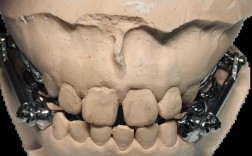 正畸的拉簧在尖牙上