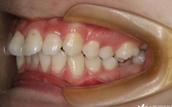 正畸后下牙错位，是矫正失败还是需要二次处理？