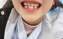 矫正器 牙齿 断了