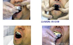 印模的灌注方法