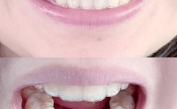 矫正过后的牙齿图片