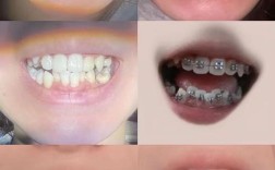 正畸期间牙齿间隙变大是正常现象吗？