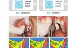 牙科粘骨牙拔除方法有哪些？难点与操作技巧是什么？