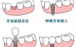 种牙二期治疗过程的具体步骤和注意事项有哪些？