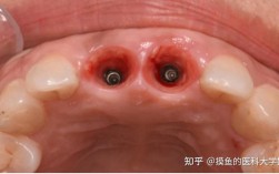 种植牙做好后，效果能维持多久？需注意哪些问题？