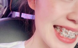 矫正牙齿后期为何要拉橡皮筋？作用、方法及时长解析？