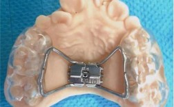 牙齿扩张器的正确使用方法是什么？新手必看的操作步骤、时长控制及注意事项有哪些？