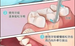 舌向阻生牙拔除方法有哪些？不同拔除技术的适应症、操作难点及临床效果如何评估？