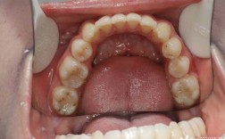 正畸二类错颌畸形矫正，有哪些关键问题需注意？