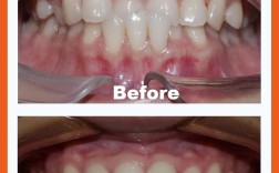 反颌正畸牙齿过程是怎样的？步骤复杂吗？周期多久？