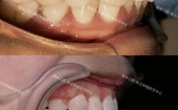 侧切牙内凹 正畸