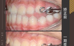 口腔正畸中的高角