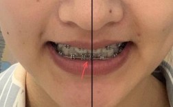 正畸之后中线偏了