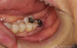 种牙后的牙齿图片大全能看出哪些真实效果？美观度和自然度跟真牙比如何？