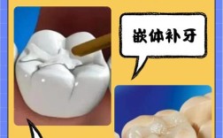 蛀牙补牙方法有哪些？哪种最适合不同蛀牙情况的治疗？