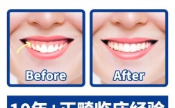 正畸露龈笑解决方案