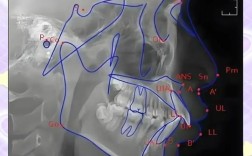 正畸头影测量z角
