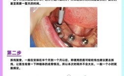 种植牙怎么做？揭秘种植牙的过程、步骤与原理