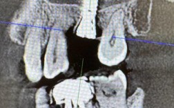 上颌窦提升在种植牙手术中到底起什么关键作用？