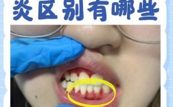 牙周炎患者做正畸治疗会有什么后果？