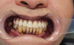 全口种牙好不好呢