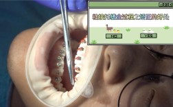 直丝弓托槽粘接方法的关键步骤、操作要点及注意事项是什么？