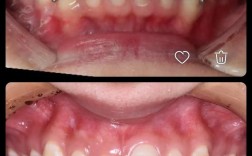 牙齿矫正为何不能频繁复诊？