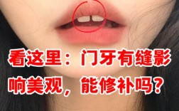 门牙有缝几种矫正方法