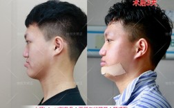 骨性地包天若仅依赖正畸矫正，效果真能达到预期吗？是否会对骨骼结构造成不良影响或增加复发风险？