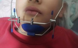 矫正牙齿牵引图片，能直观呈现哪些移动细节？