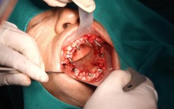 深圳allon4种植牙