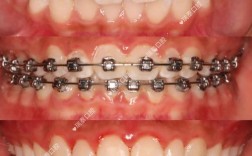 牙齿正畸spee