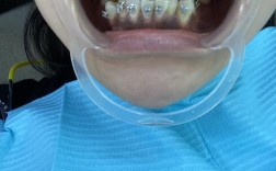 虎牙缺失牙齿矫正