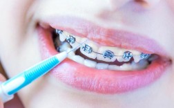 正畸保持牙周纤维带