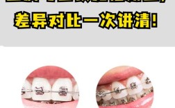 矫正牙齿的方法该怎么选才适合自己？