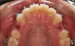 片段弓局部正畸视频