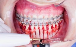 PAOO加速正畸效果如何？能显著缩短治疗时间吗？