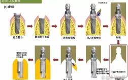 种牙要取幾次模
