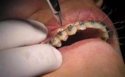 正畸弓丝串出来的操作步骤有哪些？