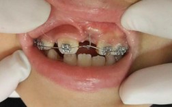 正畸牵引萌出不足