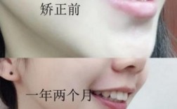 矫正牙齿有变丑的吗