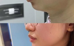 正畸后下巴会显出来吗？效果因人而异？