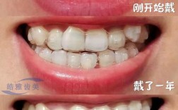 隐形牙齿矫正哪好